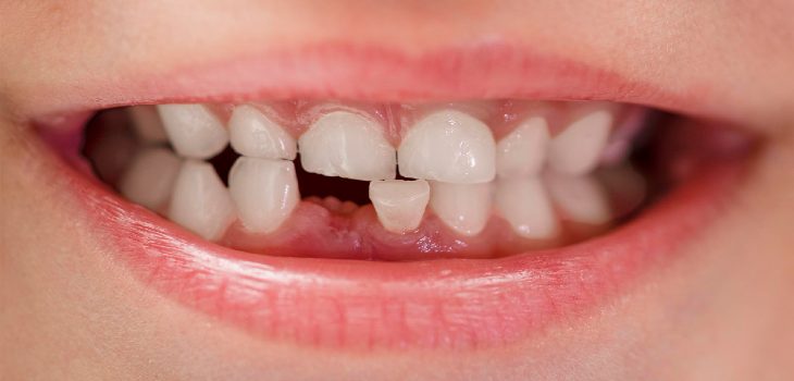 Smile of a child years old without a tooth closeup loss of child's tooth dental care