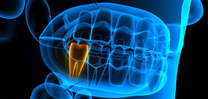 X-ray of a highlighted wisdom tooth in a jaw model