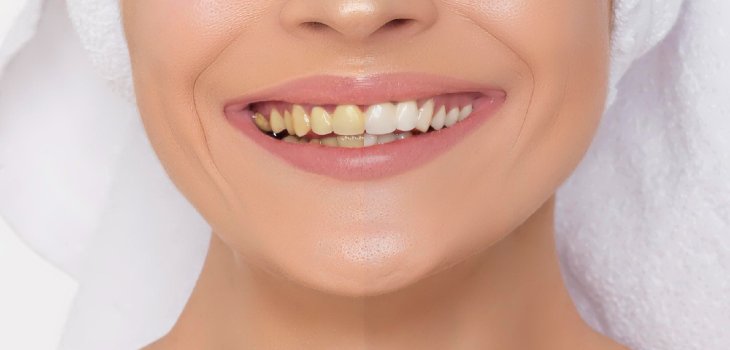 Dental health wide snowwhite female smile. Yellow Vs White teeth visible differentiation